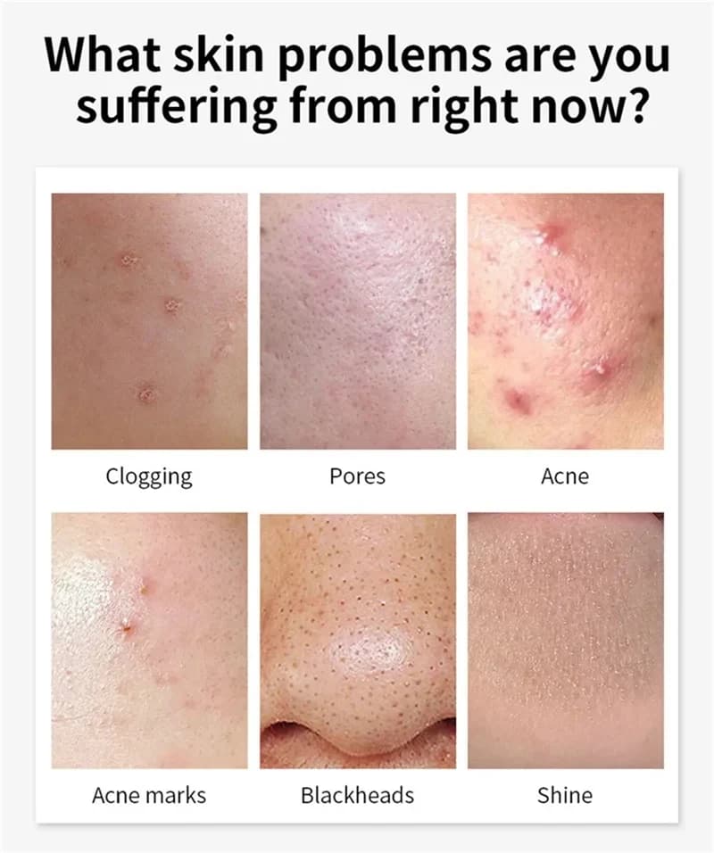 Salicylic Acid Acne Faded Face Cream Reduce Pimple Spots Deep Cleaning Pore A...
